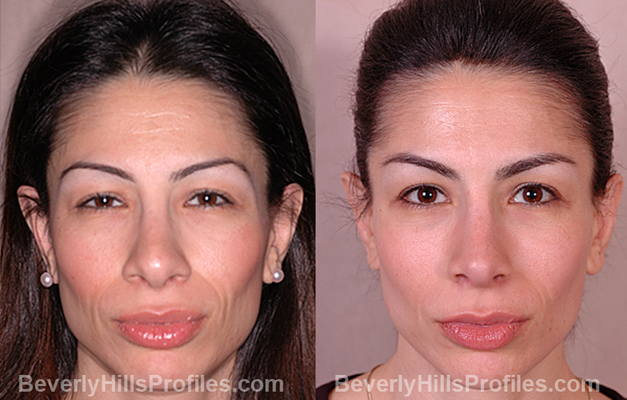 Photos Female patient before and after Revision Rhinoplasty - front view