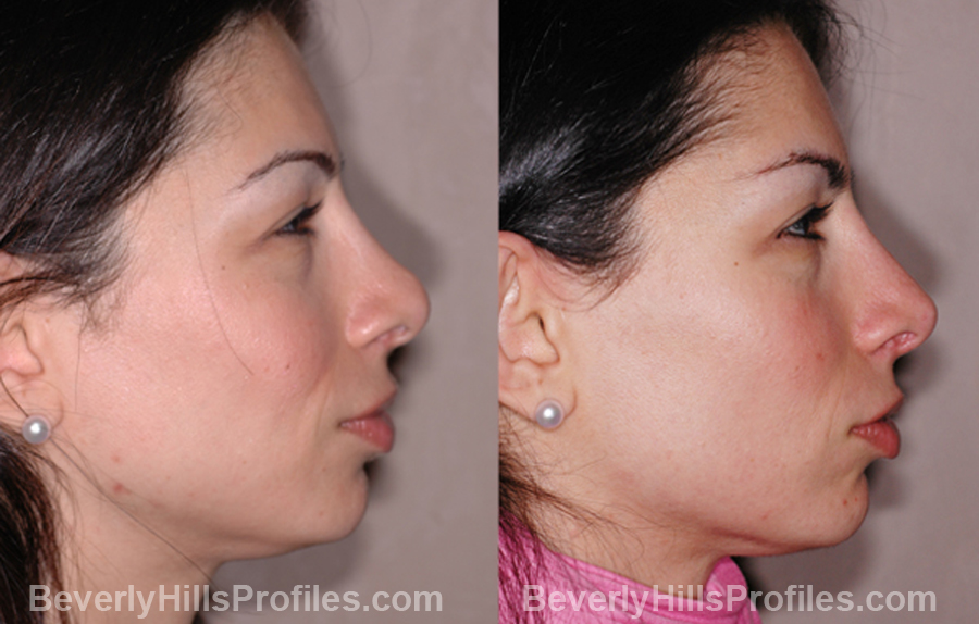 Photos Female patient before and after Revision Rhinoplasty - side view