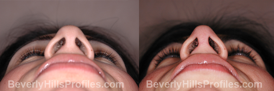 Photos Female patient before and after Revision Rhinoplasty - underside view