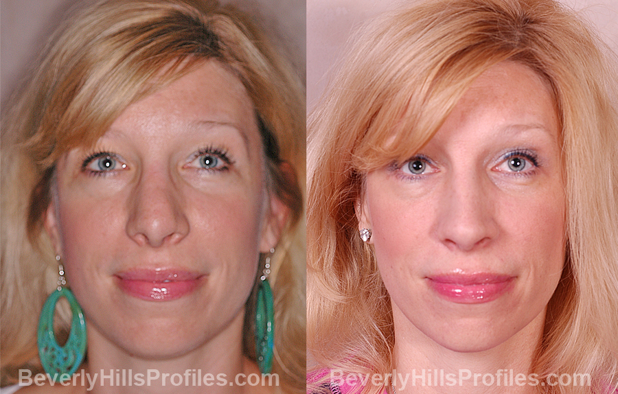 Photos Female patient before and after Revision Rhinoplasty, front view