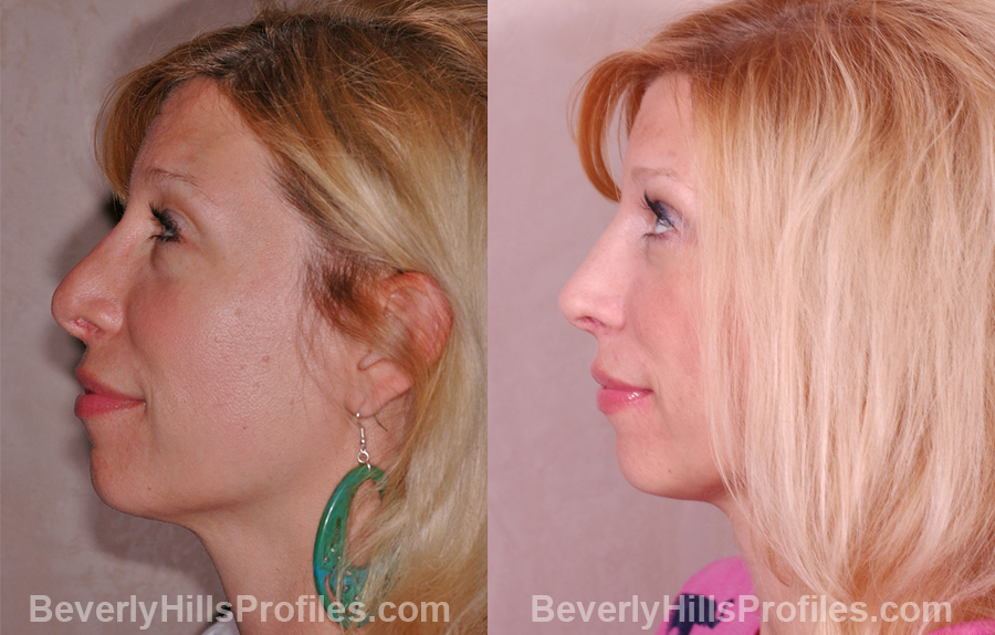 Photos Female patient before and after Revision Rhinoplasty, side view