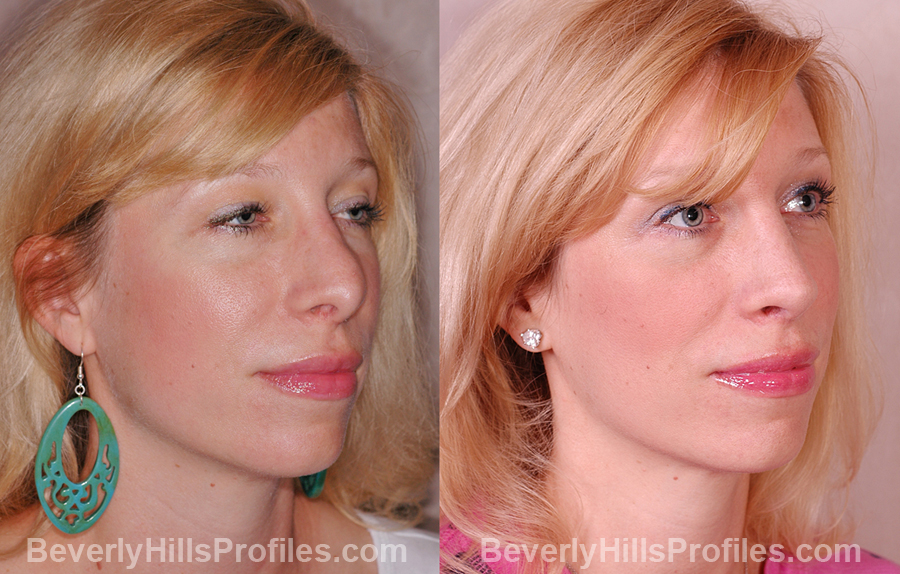 Photos Female patient before and after Revision Rhinoplasty, oblique view