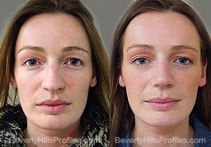 Images Female patient before and after Revision Rhinoplasty, front view