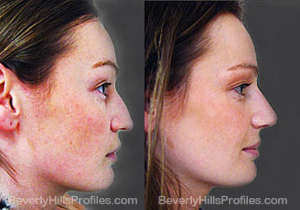 Images Female patient before and after Revision Rhinoplasty, side view