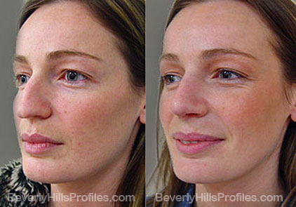 Images Female patient before and after Revision Rhinoplasty, oblique view