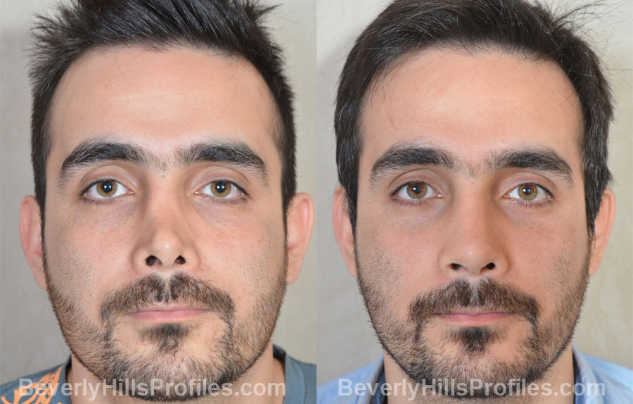 Male patient before and after Revision Rhinoplasty - front view