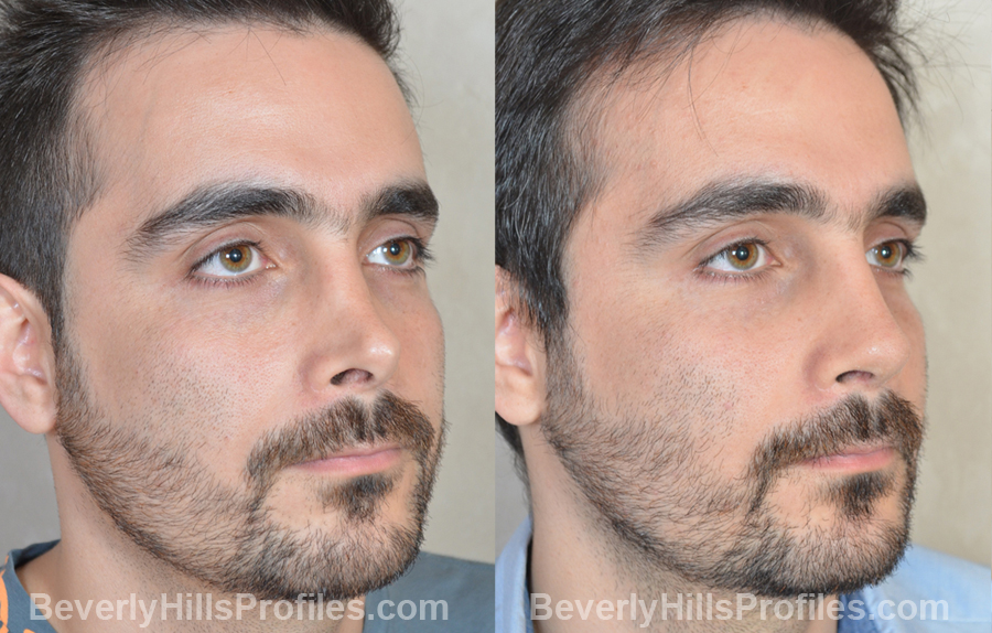 Male patient before and after Revision Rhinoplasty - oblique view