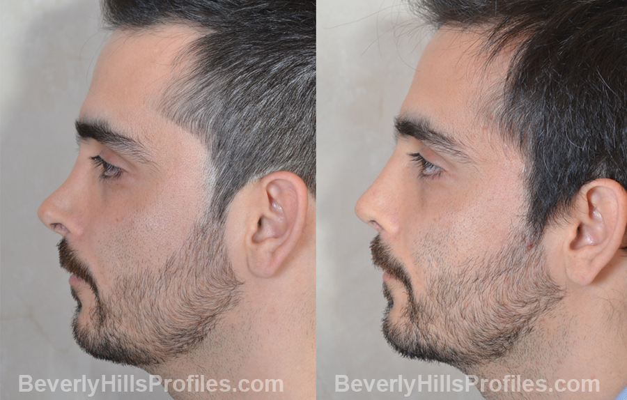 Male patient before and after Revision Rhinoplasty - side view