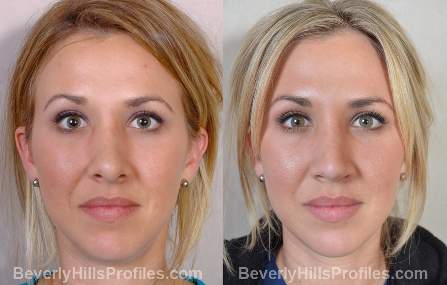 Images Female before and after Revision Rhinoplasty - front view