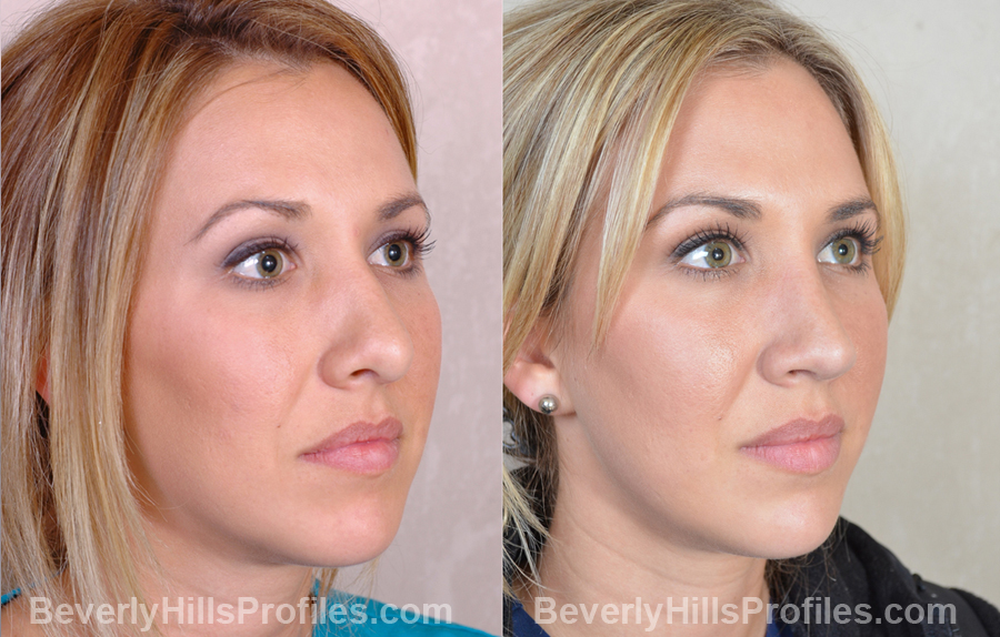 Images Female before and after Revision Rhinoplasty - oblique view