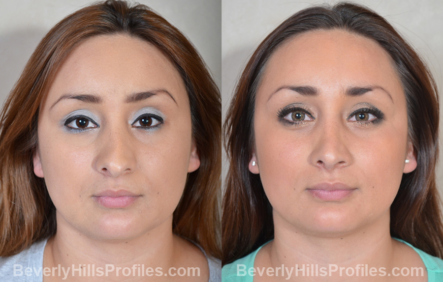 Images Female patient before and after Revision Rhinoplasty - front view