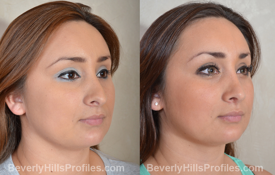 Images Female patient before and after Revision Rhinoplasty - oblique view