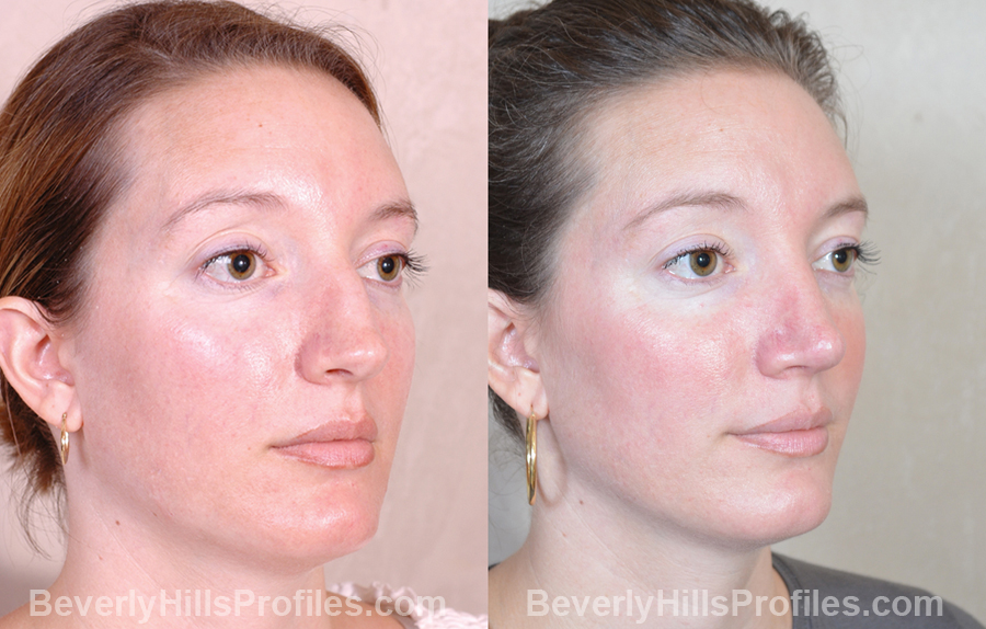 Female patient before and after Revision Nose Surgery - oblique view