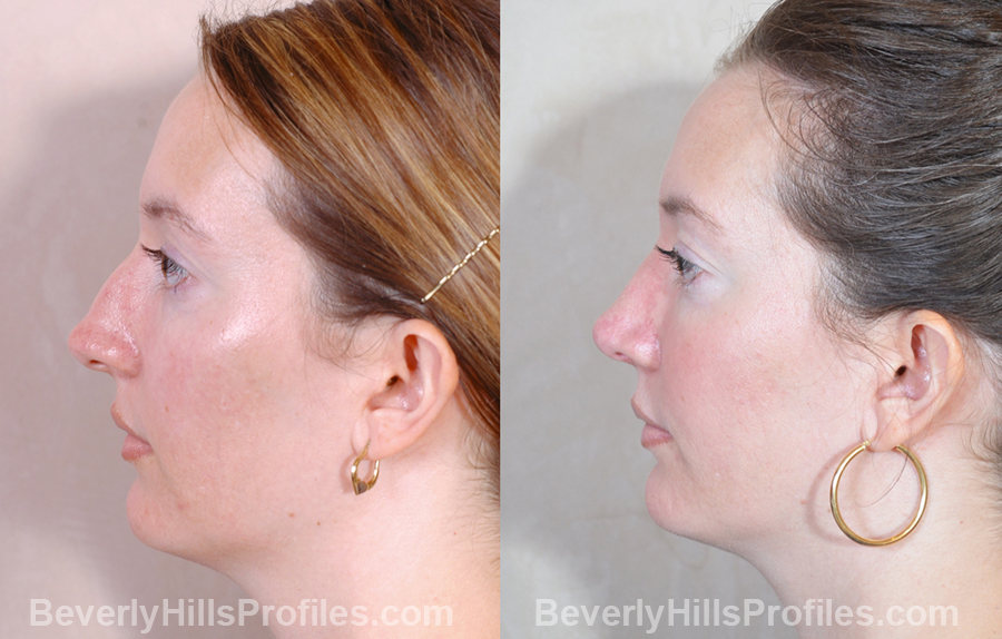 Female patient before and after Revision Nose Surgery - side view