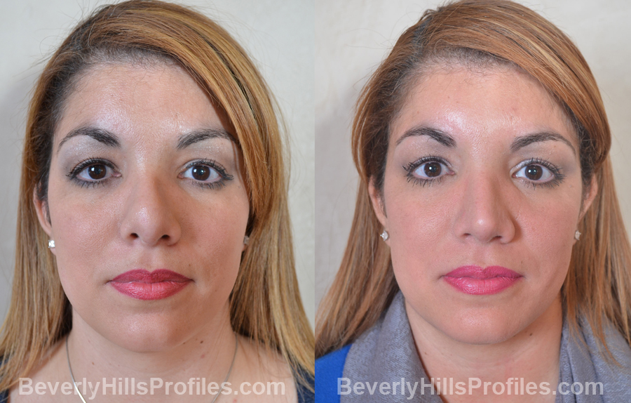 Female patient before and after Revision Nose Surgery - front view