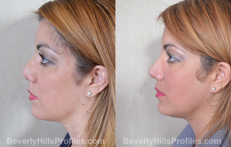 Female patient before and after Revision Nose Surgery - side view