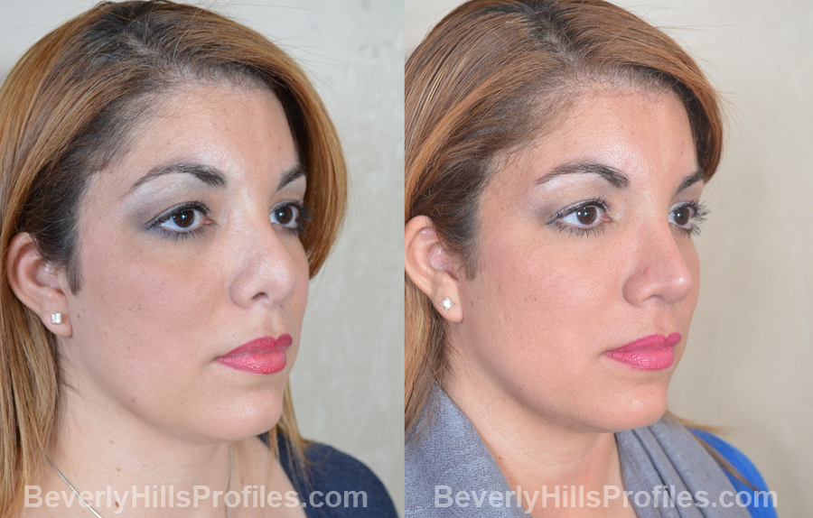 Female patient before and after Revision Nose Surgery - oblique view