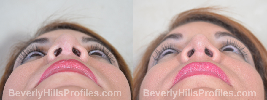 Female patient before and after Revision Nose Surgery - underside view