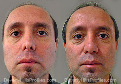 Male patient before and after Revision Nose Surgery - front view