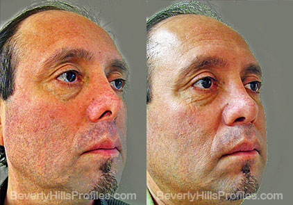 Male patient before and after Revision Nose Surgery - oblique view