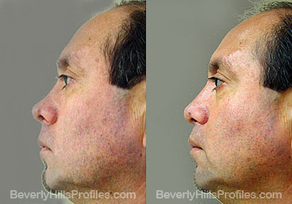 Male patient before and after Revision Nose Surgery - side view