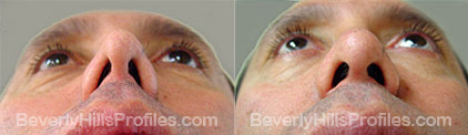 Male patient before and after Revision Nose Surgery - underside view
