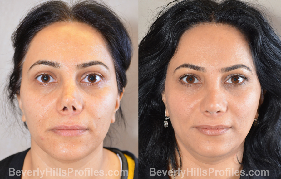 Female patient before and after Revision Rhinoplasty - front view