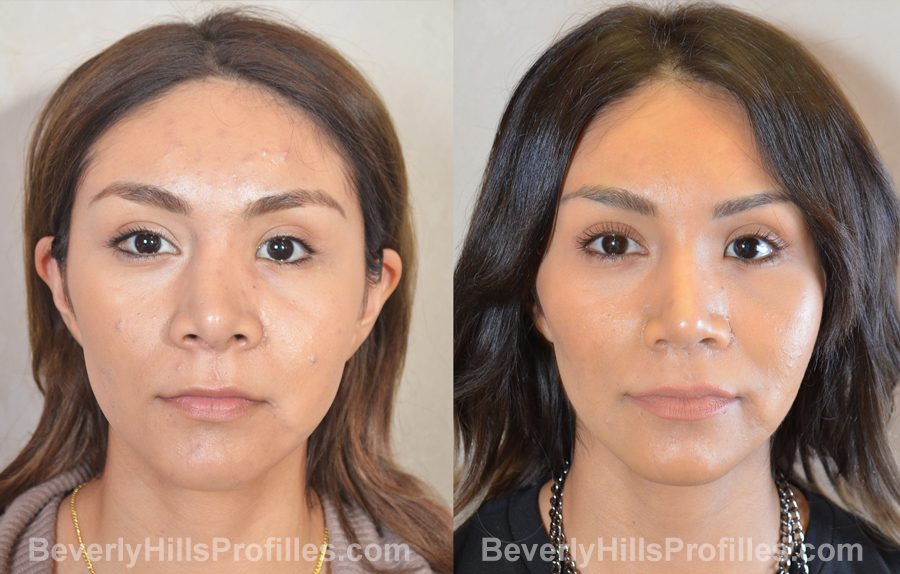 Female before and after Revision Nose Surgery - front view