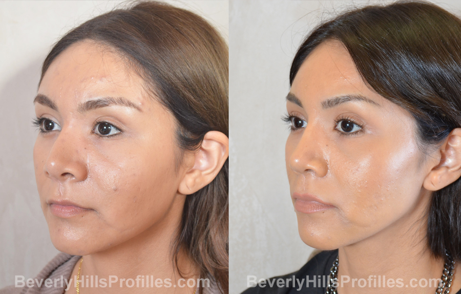 Female before and after Revision Nose Surgery - oblique view
