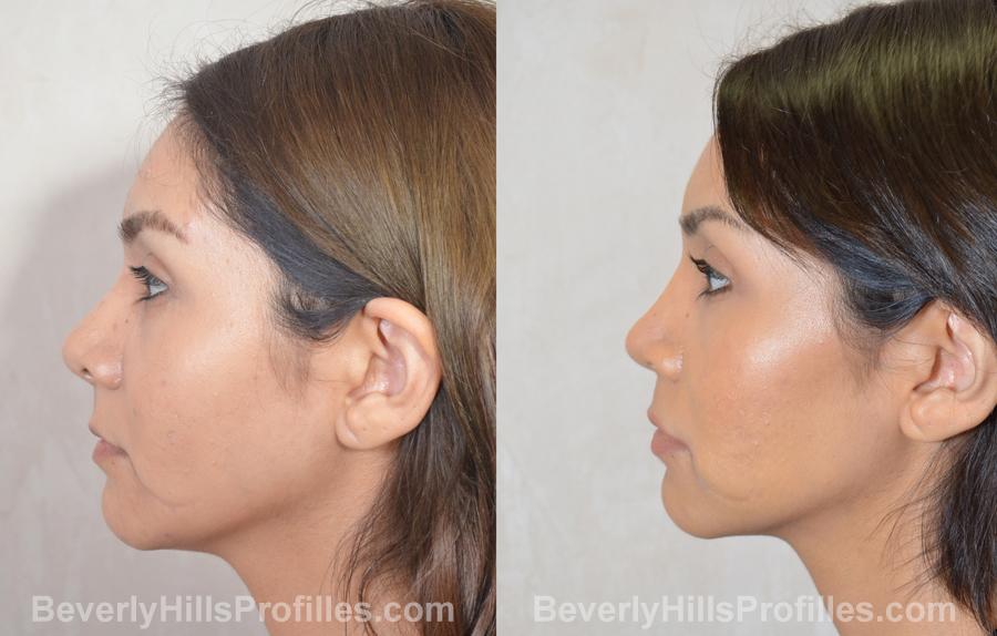 Female before and after Revision Nose Surgery - side view