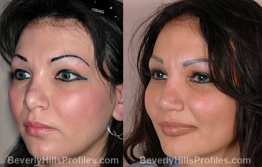 oblique view Female before and after Revision Rhinoplasty