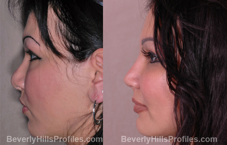 side view Female before and after Revision Rhinoplasty