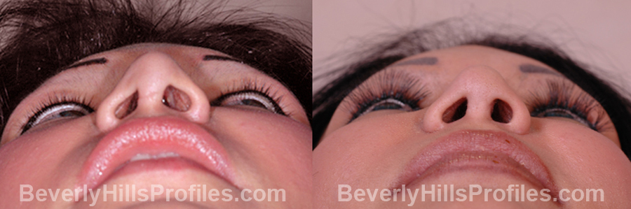 underside view Female before and after Revision Rhinoplasty