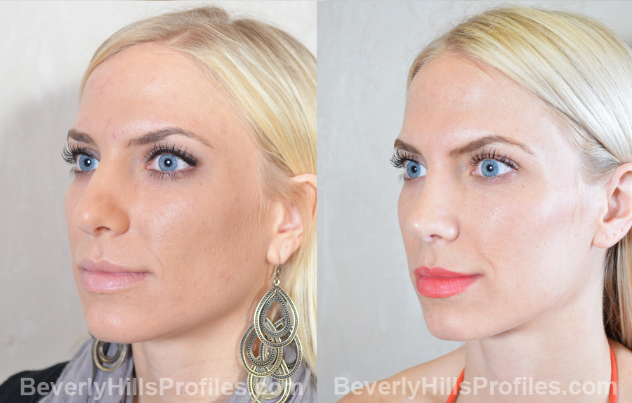 oblique view Female patient before and after Revision Rhinoplasty