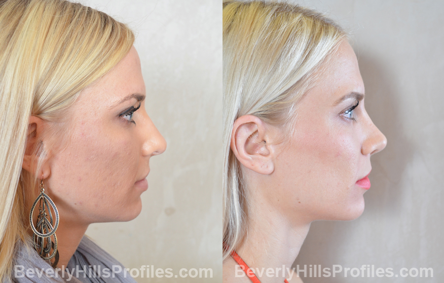 side view Female patient before and after Revision Rhinoplasty