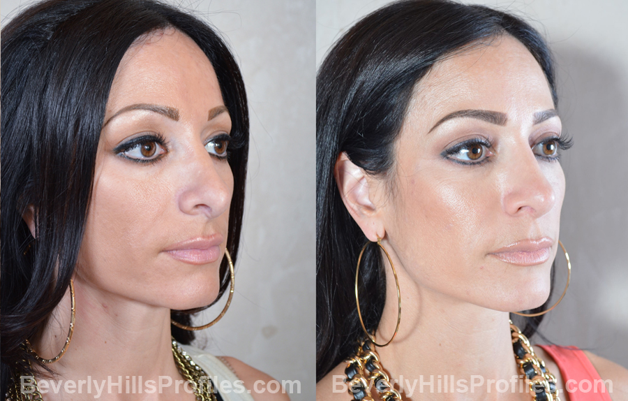 oblique view - Female patient before and after Revision Rhinoplasty