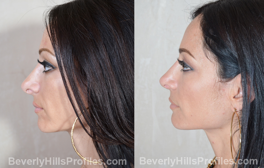 side view - Female patient before and after Revision Rhinoplasty