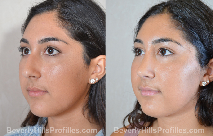 photos Female before and after Facelift, oblique view