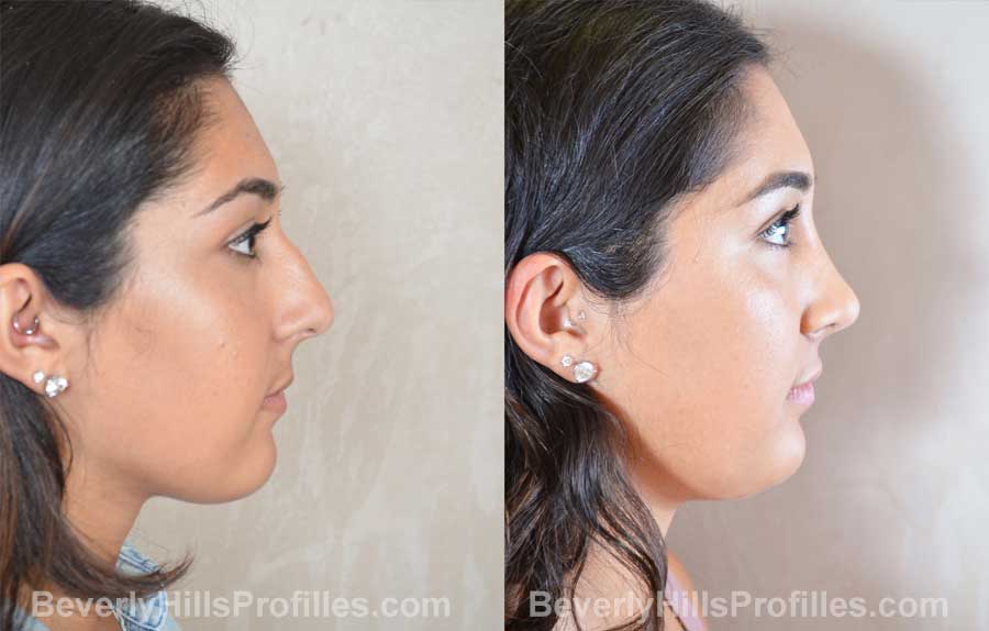 photos Female before and after Facelift, side view