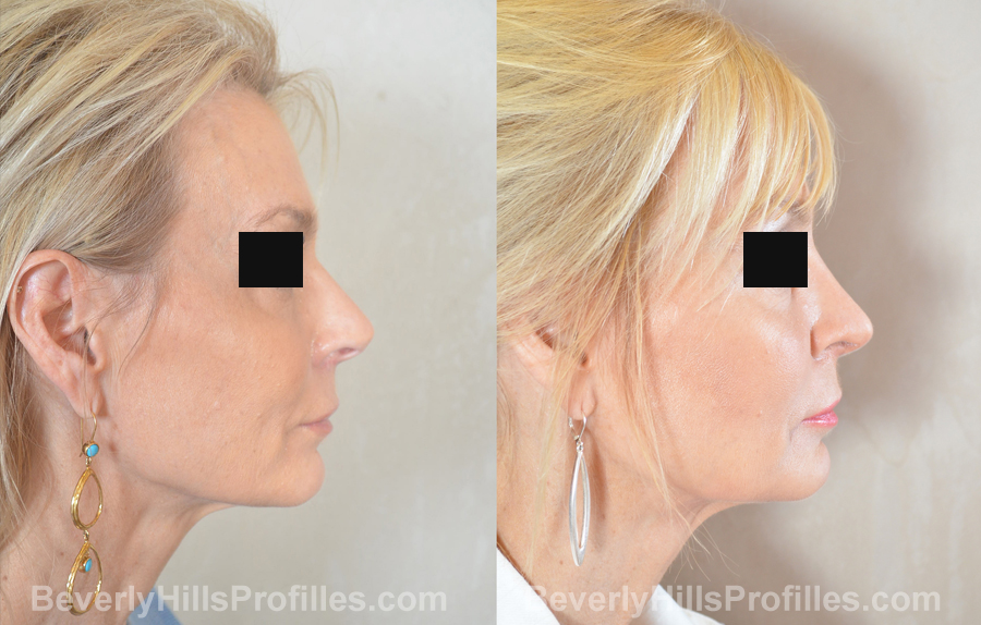 imgs Female before and after Nose Surgery side view