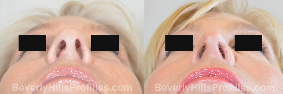 imgs Female before and after Nose Surgery underside view