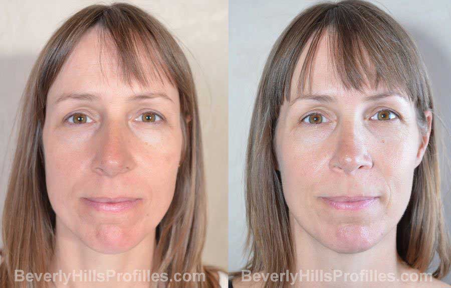 imgs Female before and after Nose Surgery - front view