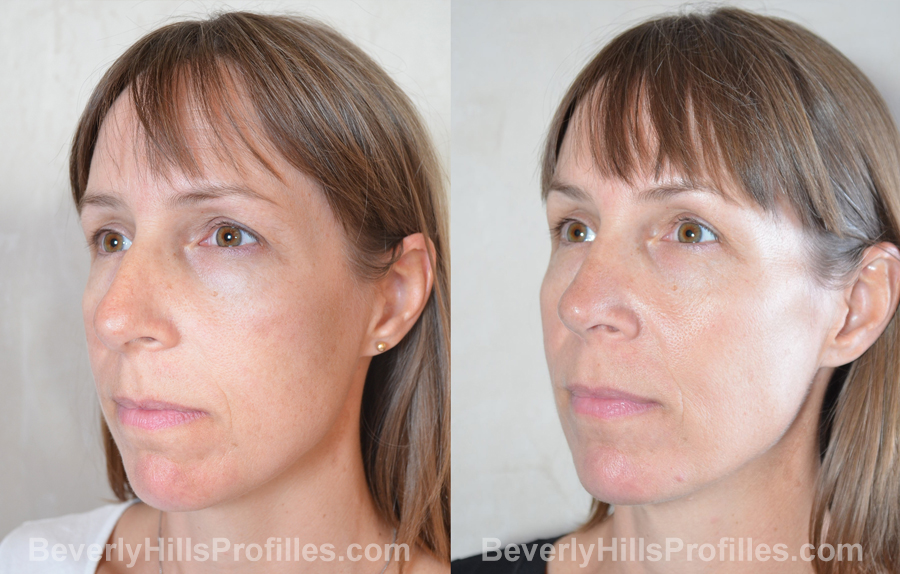 imgs Female before and after Nose Surgery - oblique view