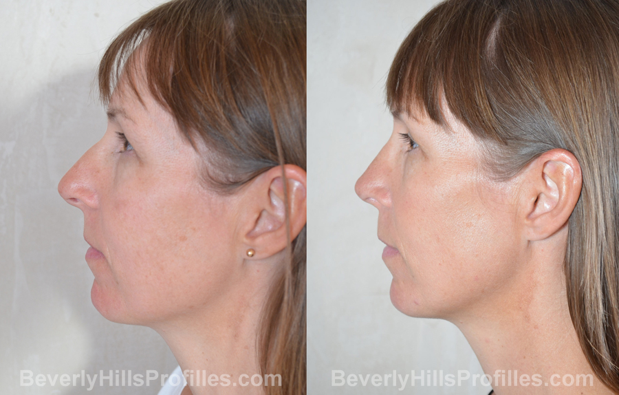 imgs Female before and after Nose Surgery - side view