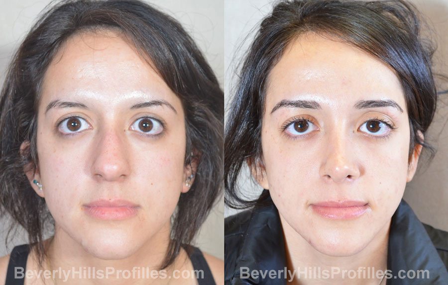 imgs Female before and after Nose Surgery, front view