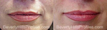 Wrinkle Fillers Before & After Photos