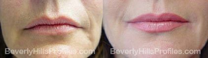 Photos Wrinkle Fillers Before & After