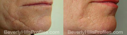 Photos Wrinkle Fillers Before and After