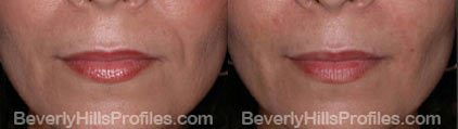 Images Wrinkle Fillers Before & After