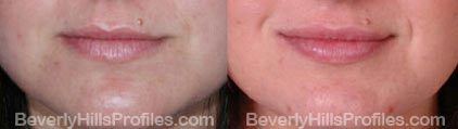 Images Wrinkle Fillers Before and After